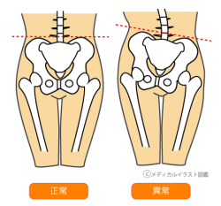 骨盤画像