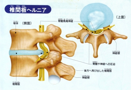 椎間板ヘルニア